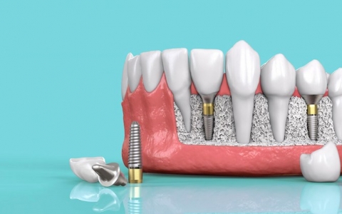 Cấy Ghép Răng Implant Ở Đâu Tốt, Tiêu Chí Cần Biết Để Lựa Chọn Địa Chỉ Cấy Ghép Implant